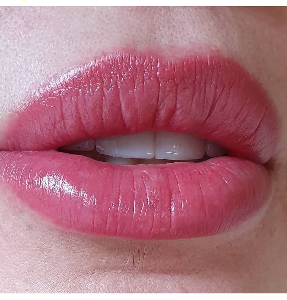 Dermo en labios - Imagen 1