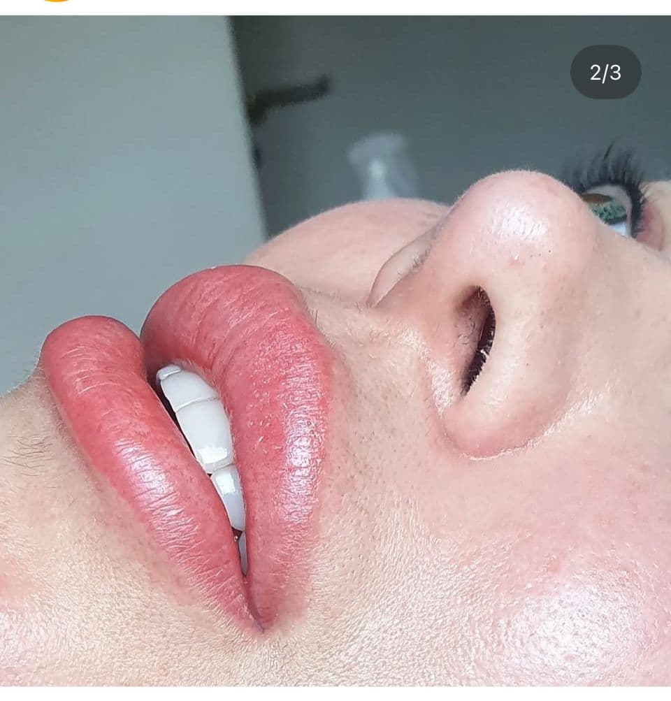 Dermo en labios - Imagen 3