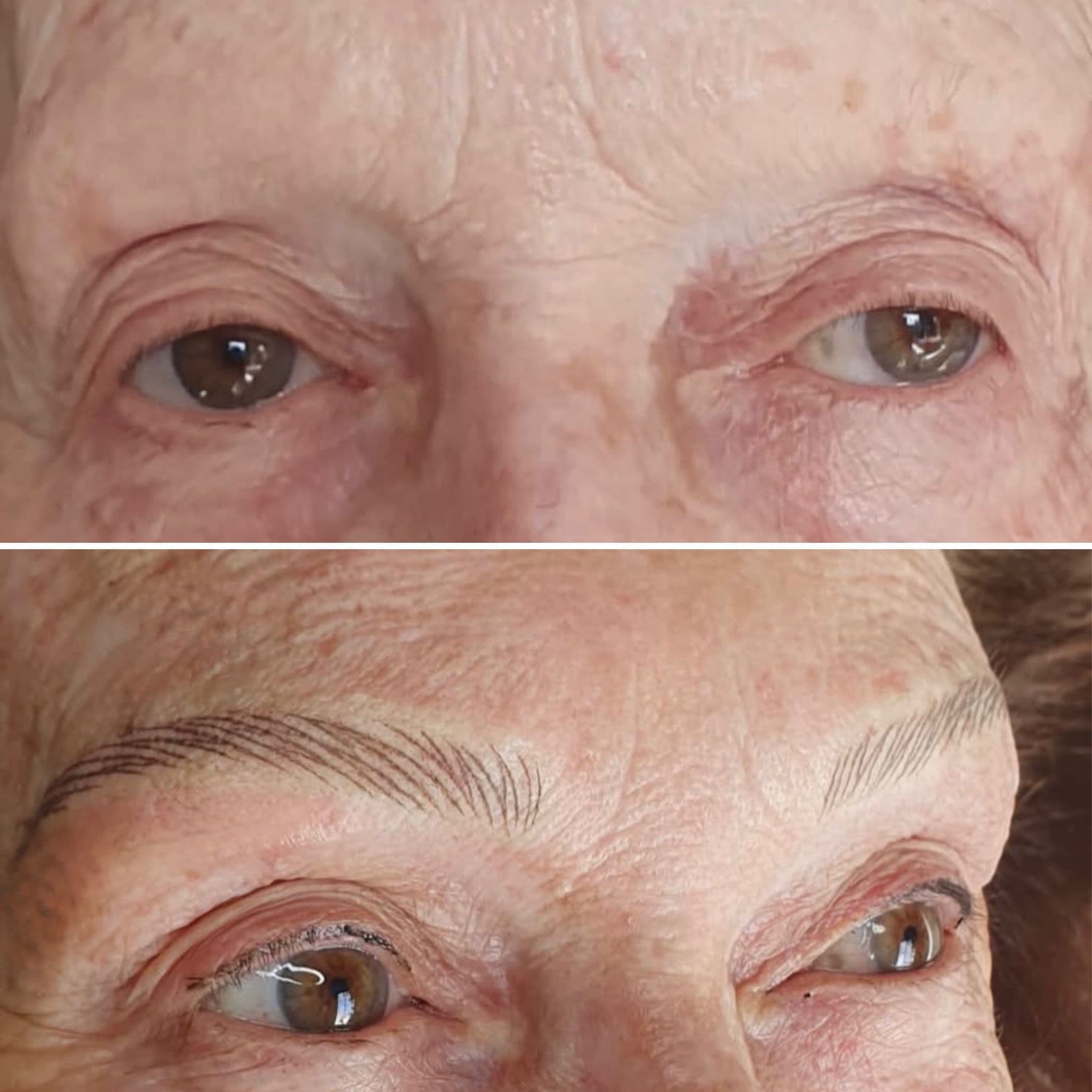 Cejas hiperrealistas en casos alopécicos - Imagen 1