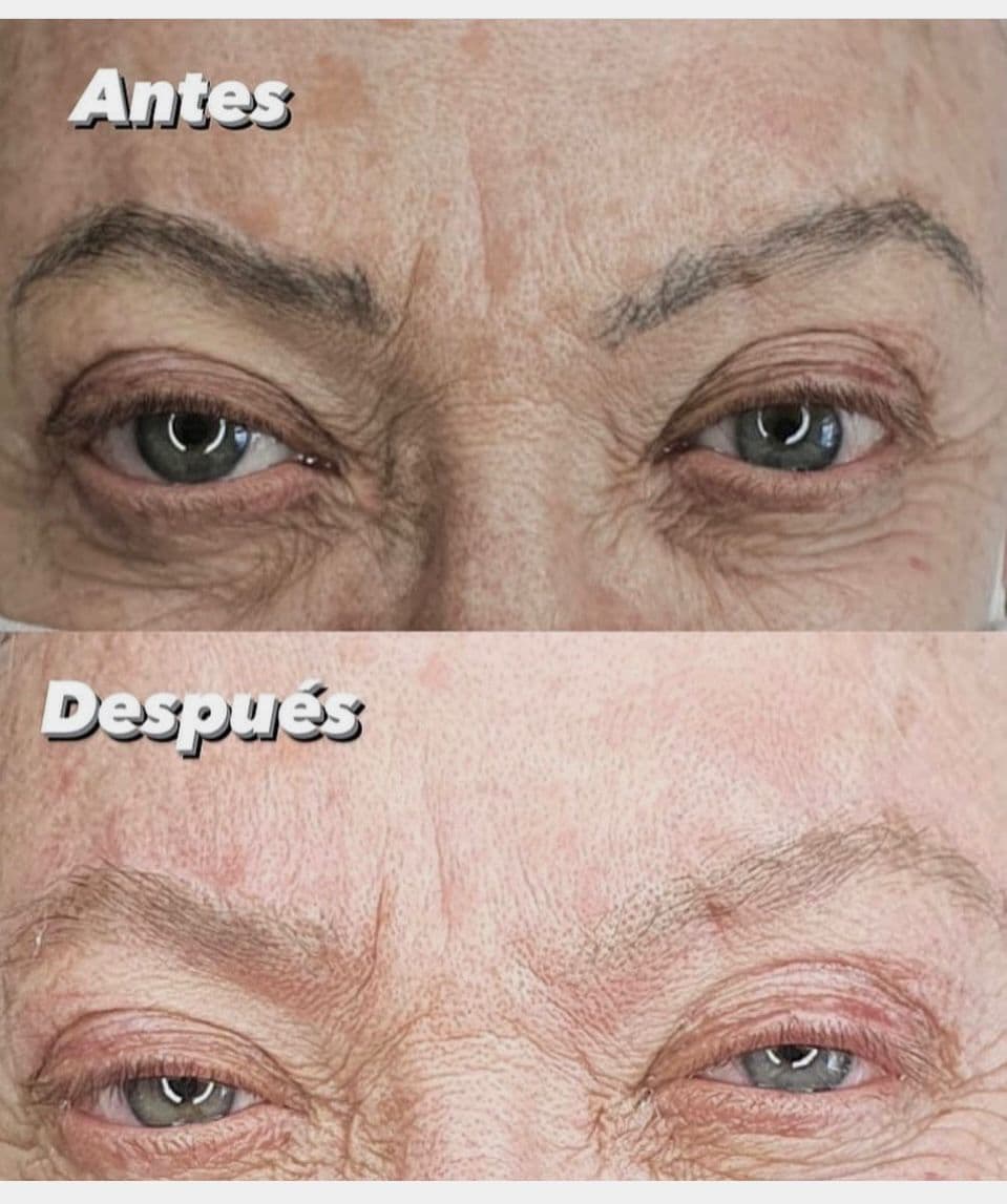 Láser removal - Imagen 1