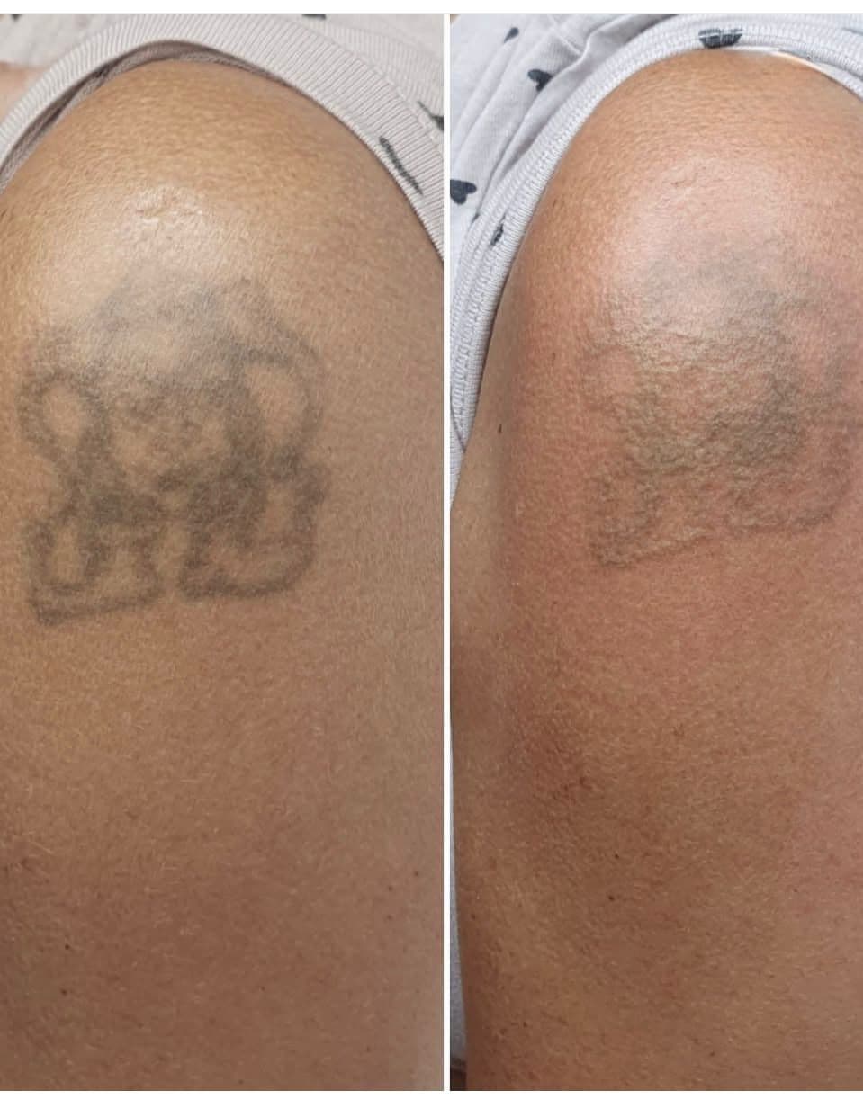 Láser removal - Imagen 2
