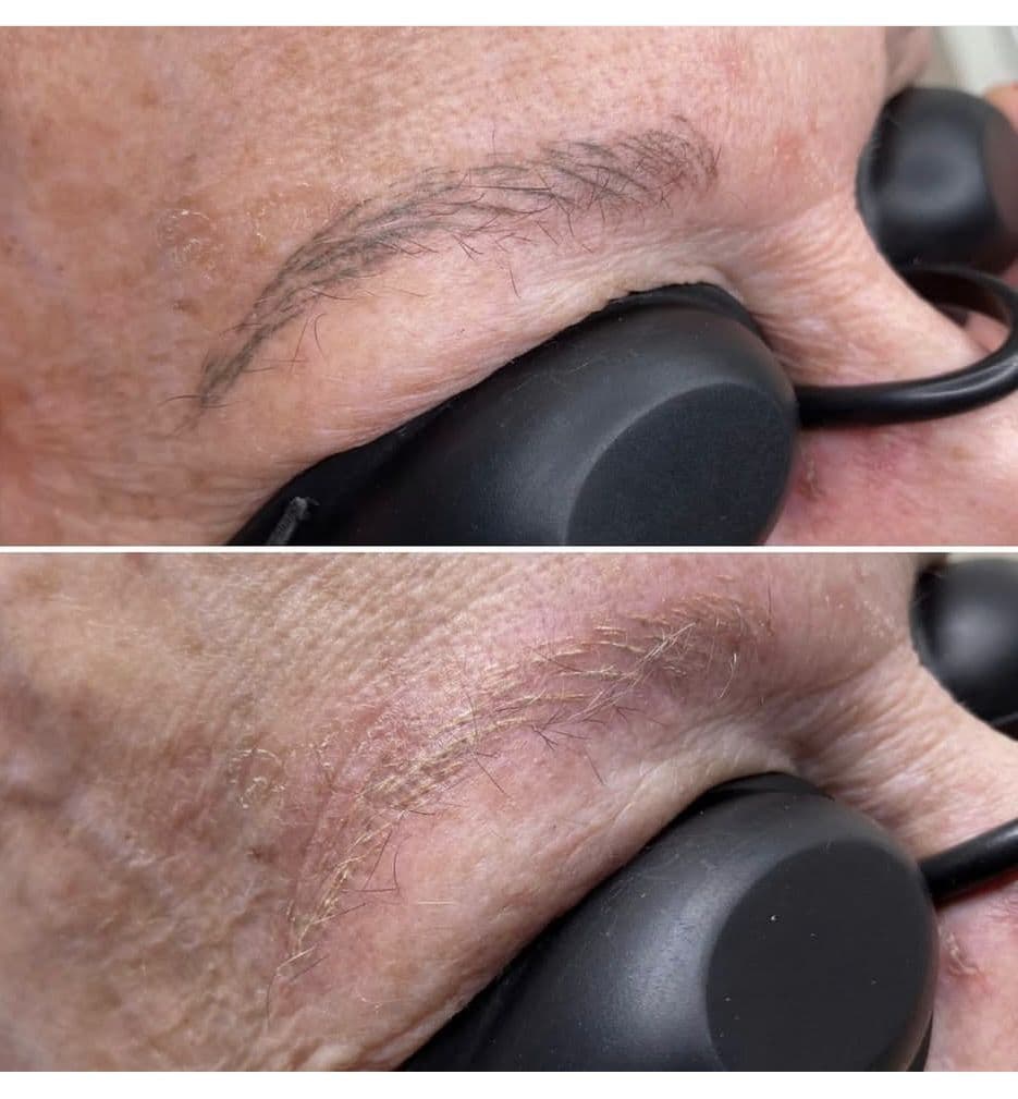 Láser removal - Imagen 4